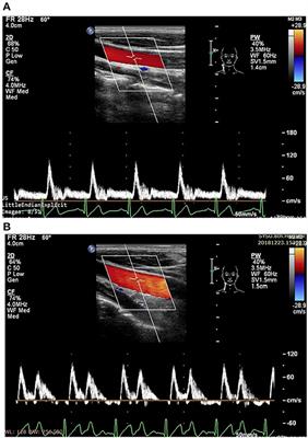 Acute Hemodynamic Responses to Enhanced External Counterpulsation in Patients With Coronary Artery Disease